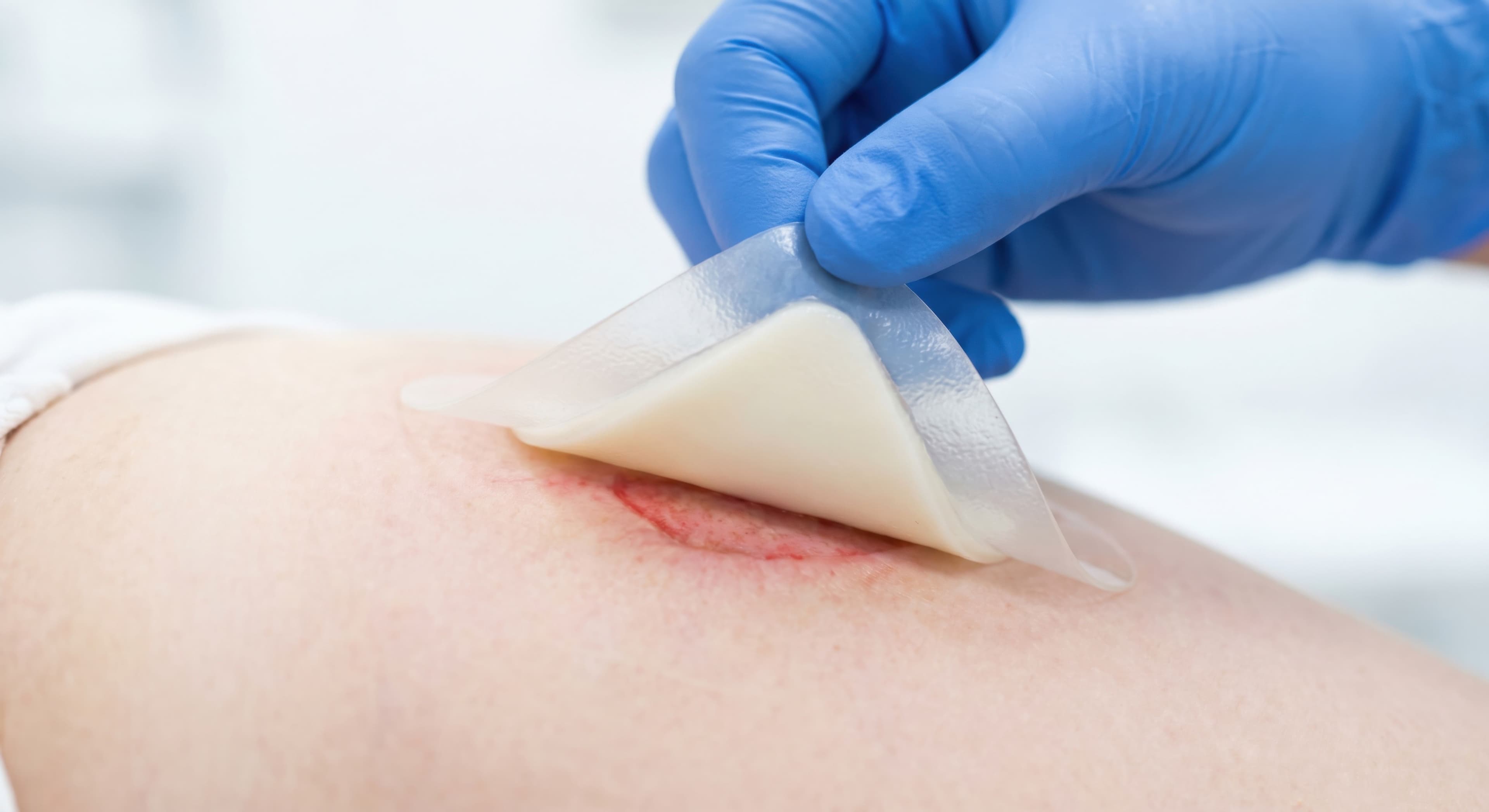 Pressure Ulcer Staging Guide